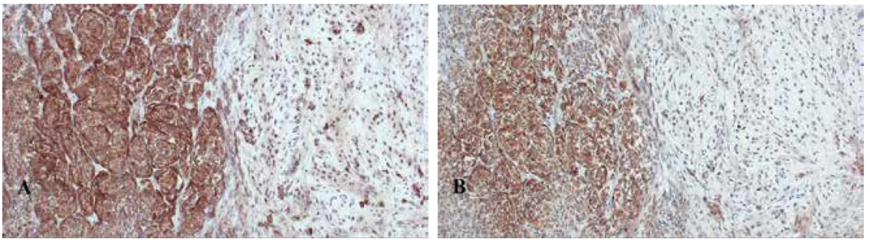Imunohistochemický průkaz HMB-45 (A) a melan A (B) v nádorových melanocytech (IHC, zvětšeno 10x).