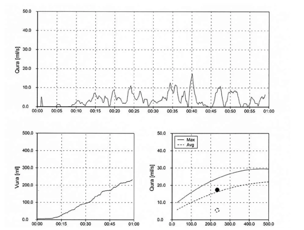 Domácí uroflowmetrie – Staccato křivka s použitím břišního lisu<br>
Fig. 4. Home uroflowmetry – Staccato curve using an abdominal press