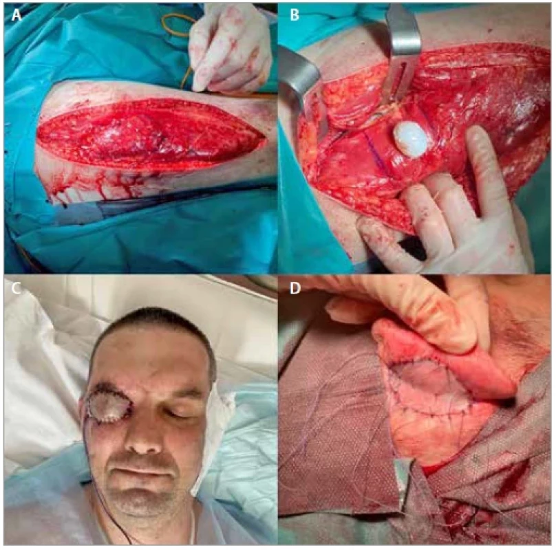 (A) Dissection of the vastus lateralis muscle flap; (B) acrylic conformer
implant; (C) coverage of the vastus lateralis muscle flap with the full-thickness
skin graft from the retroauricular area; (D) closure of the secondary defect in
the retroauricular area with the split-thickness skin graft from the contralateral
thigh.