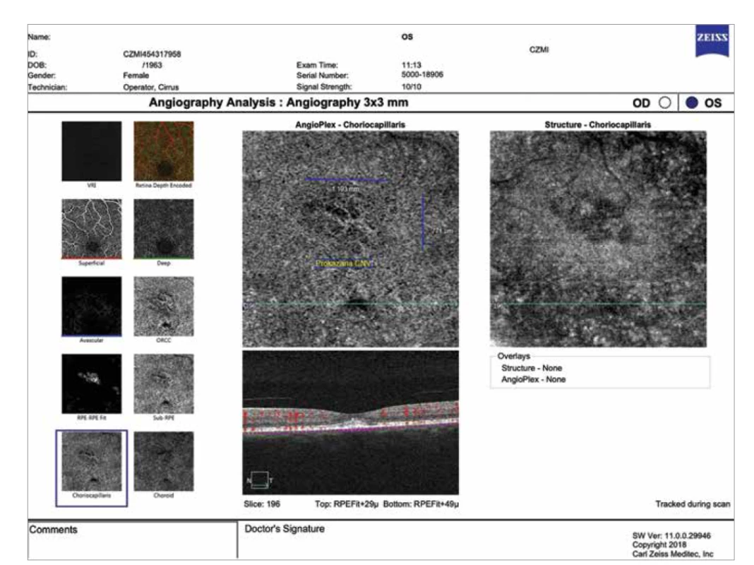 Optická koherenční tomografická angiografie stejné pacientky 1 rok po provedené redukované fotodynamické terapii (Angioplex
Zeiss Cirrus 5000, Carl Zeiss Meditec): v místě původního aktivního ložiska pod undulujícím retinálním pigmentovým epitelem
v zóně choriokapilaris je jasně zřetelná inaktivní choroidální neovaskularizace (žlutá šipka)