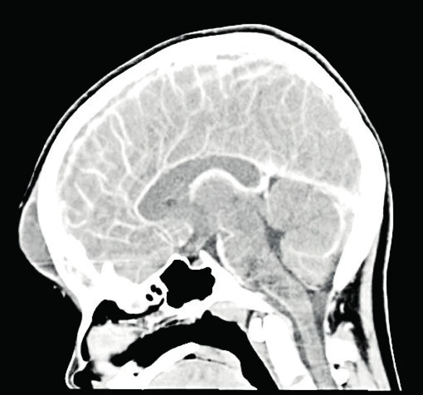 a, b (P1). Vstupní CT (1. hospitalizační den), ložisko
cerebritidy frontálně vpravo a subperiostální
absces po aplikaci kontrastní látky. (Za laskavého přispění MUDr. Pavla Rejtara)<br>
Fig. 3a, b (P1). The CT imaging (the first hospitalisation day),
the area of cerebritis in the right frontal area
and subperiosteal abscess after the contrast
agent administration. (Credit Dr. Pavel Rejtar)
