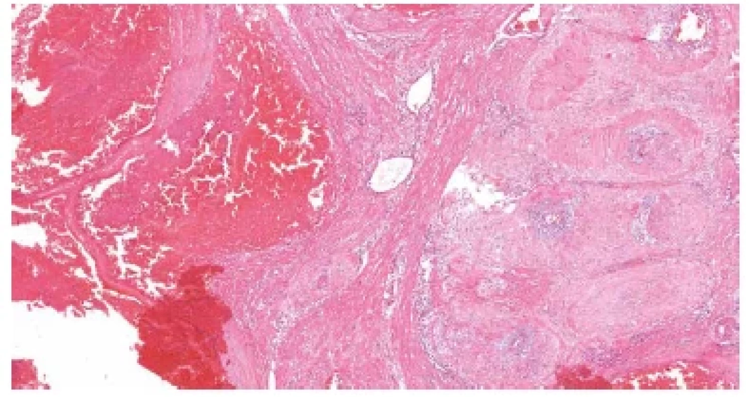 Subinvoluce cév lůžka placenty (placental site subinvolution). Útržky
myometria, v němž současně nacházíme volně průchodné i fyziologicky
uzavřené uteroplacentární cévy (HE, 50x).