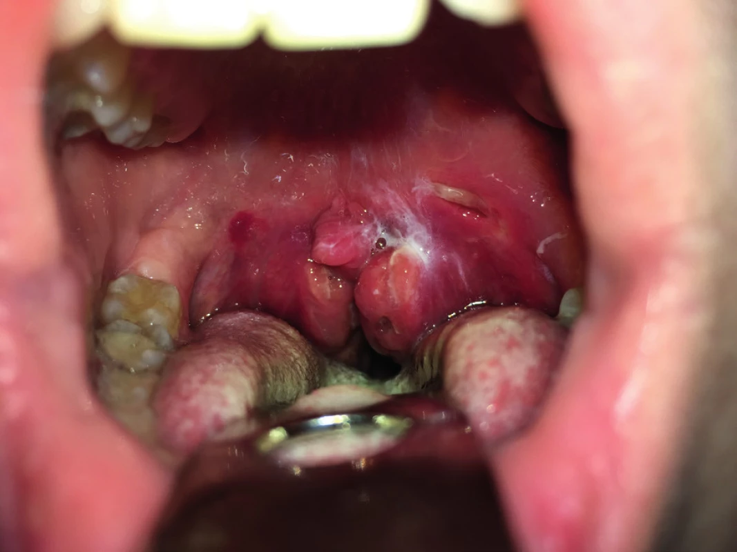 Lokálny predoperačný nález u 16-ročnej pacientky
(hypertrofia podnebných mandlí s 95% obturáciou hltanovej úžiny,
nedislokovaná uvula, incízia peritonzília obojstranne s hnisovým
obsahom).