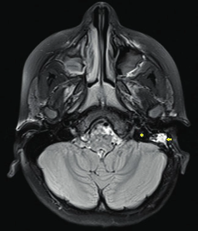 MRI, FLAIR, pooperačně, rekanalizace bulbu v. jugularis
interna vlevo (hvězdička), pooperační změny ve středoušní dutině
(šipka), nejsou známky opacifikace hrotu