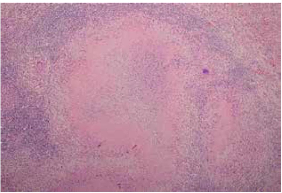 Histologický nález TBC sleziny – mikroskopie<br>
Fig. 2. Histological finding of splenic TBC – microscopy
