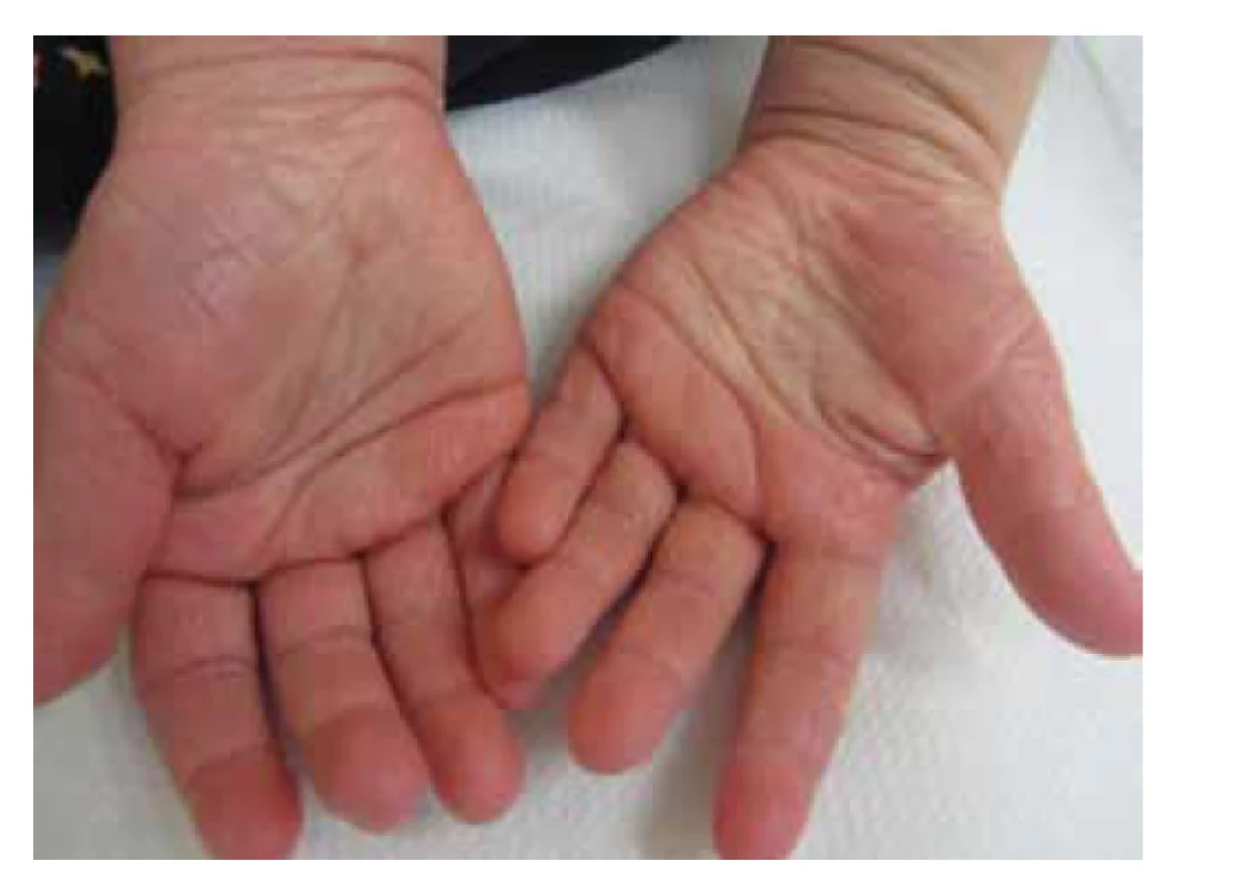 Hyperlinearita ve dlaních je klinickou známkou
mutace filagrinu, ruce atopika
