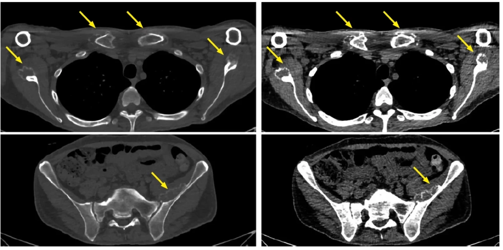 Nativní celotělové low dose CT vyšetření v kostním a měkkotkáňovém přepočtu zobrazuje četné extraoseální, paraskeletální infiltráty navazující přímo na kosti (lopatky, klíční kosti) s periferním kalcifikovaným lemem