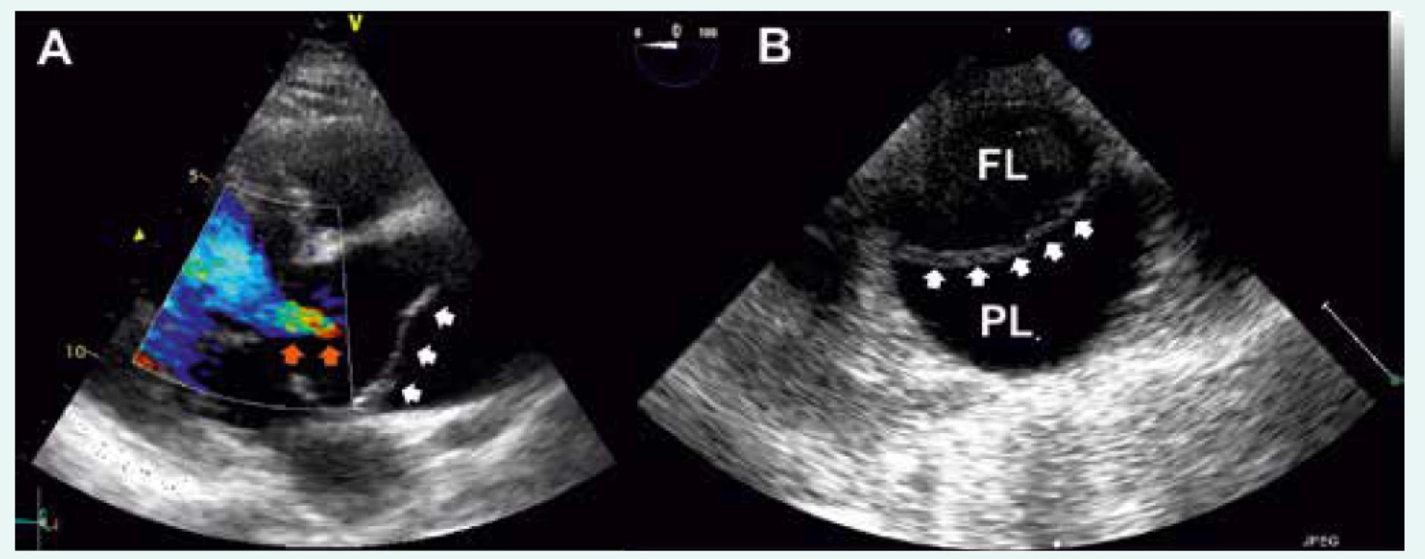 Akutní aortální disekce typu A dle Standfordské klasifikace při vyšetření TTE