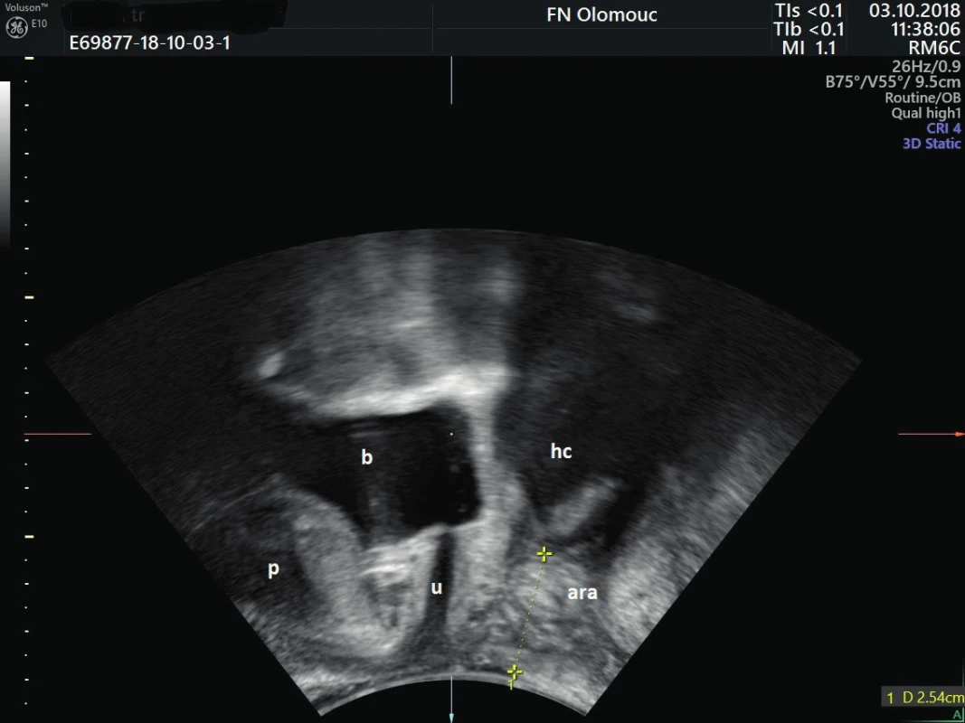 Ultrazvukový snímek malé pánve snímaný konvexní
abdominální sondou z perineálního přístupu – měření vzdálenosti
distálního pólu hematokolpos a perinea
b – močový měchýř, u – uretra, p – symfýza, ara – anorektální úhel,
hc – hematokolpos