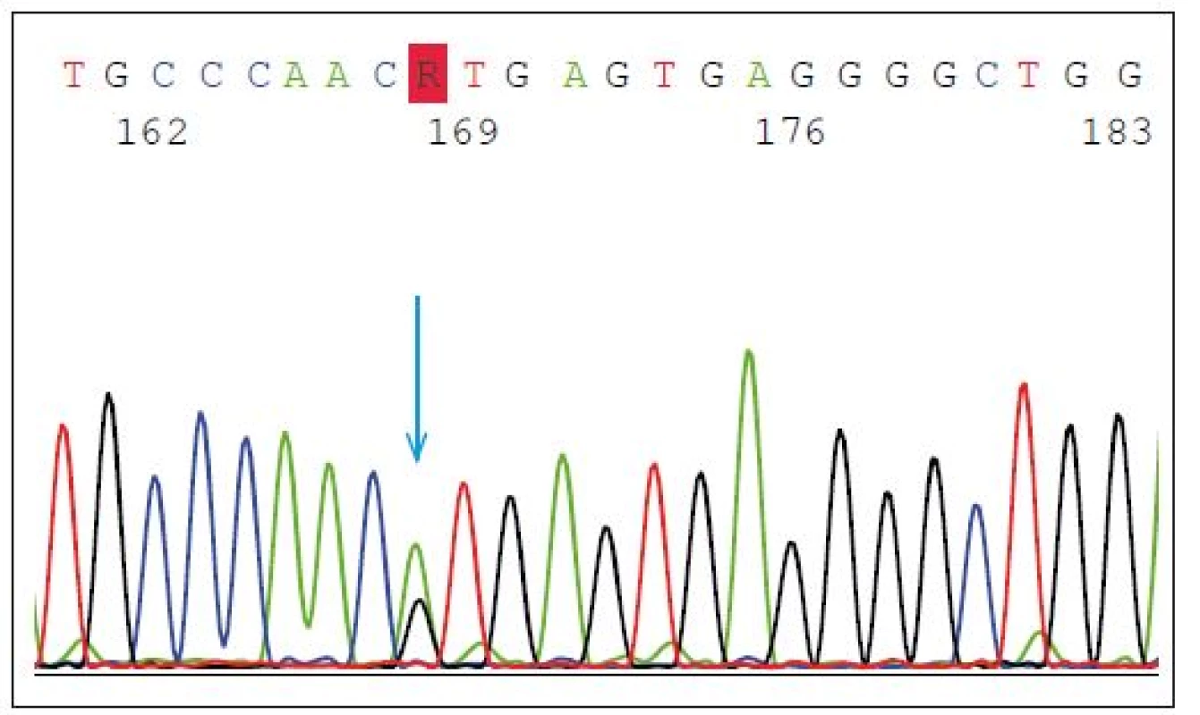 Heterozygotní mutace v místě sestřihu (tzv. splice-site) p.Val200Glyfs*18
(p.V200GfsX18) v genu GRN. Modrá šipka znázorňuje bodovou mutaci v intronu 7
(IVS7 + 1G > A), kde se předpokládá přeskočení exonu 7, posun čtecího rámečku a předčasné
ukončení translace, které způsobí degradaci transkriptu.<br>
Fig. 2. Heterozygous splice-site mutation p.Val200Glyfs*18 (p.V200GfsX18) in GRN gene.
The blue arrow shows the point mutation in intron 7 (IVS7 + 1G > A) splice donor site predicted
to cause exon 7 skipping, frameshift and premature translation termination, and is
demonstrated to result in transcript degradation.