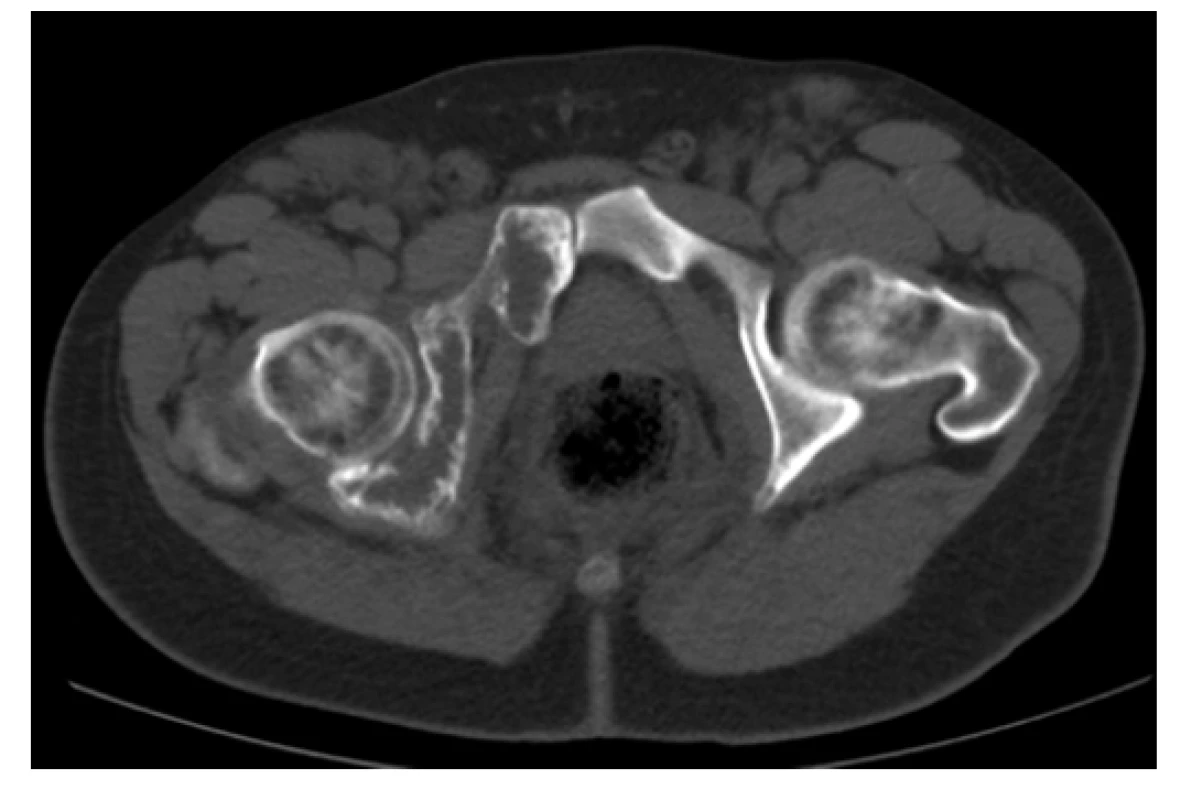CT scan (axiální rovina), kostní okno – osteolytické změny acetabula
a os pubis vpravo
