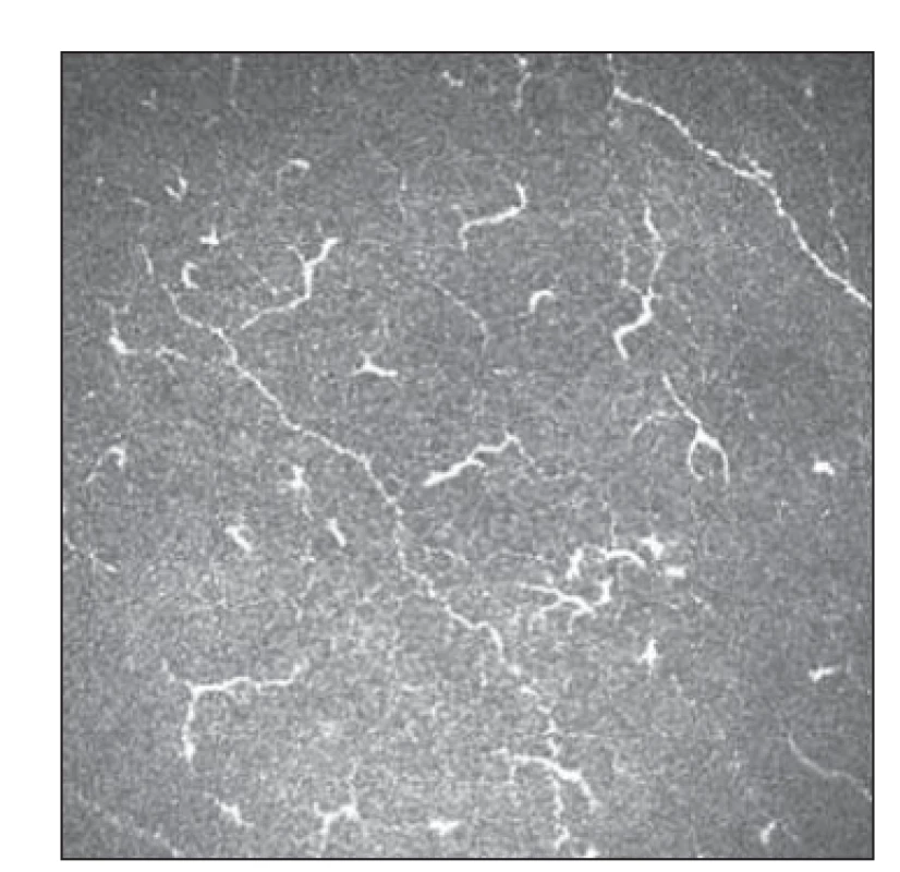Patologické postižení tenkých vláken
s patrnou aktivitou Langerhansových
buněk 1.<br>
Fig. 5. Small fiber pathology with Langerhans
cell activity 1.