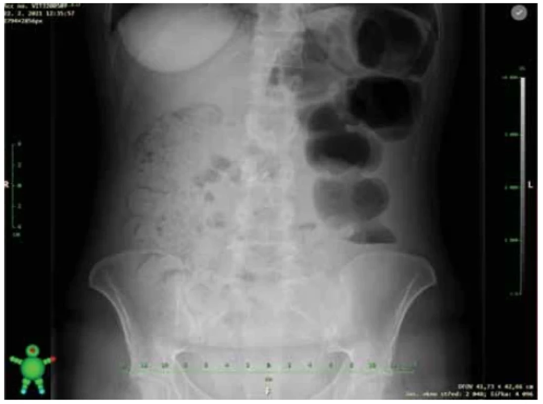 X-ray image of abdomen with ileus sign. <br> 
Obr. 2. Prostý rentgenový snímek břicha s nálezem ileózního stavu.