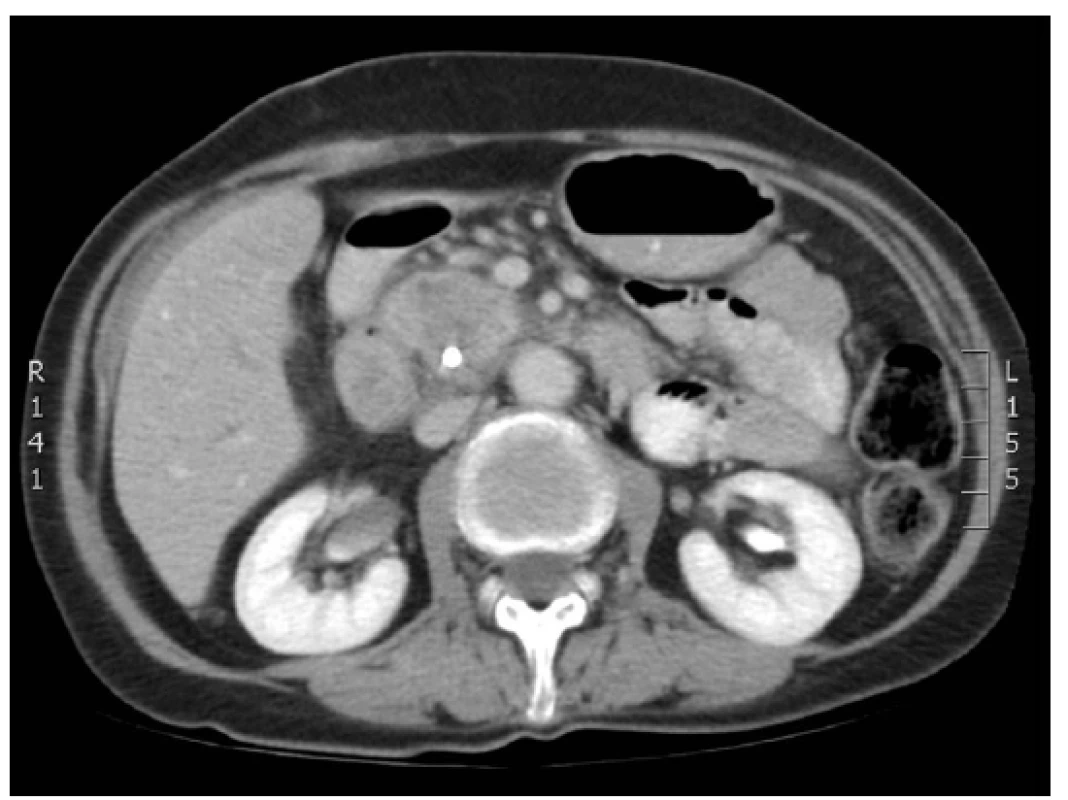Preoperative CT scan of pancreatic head tumour