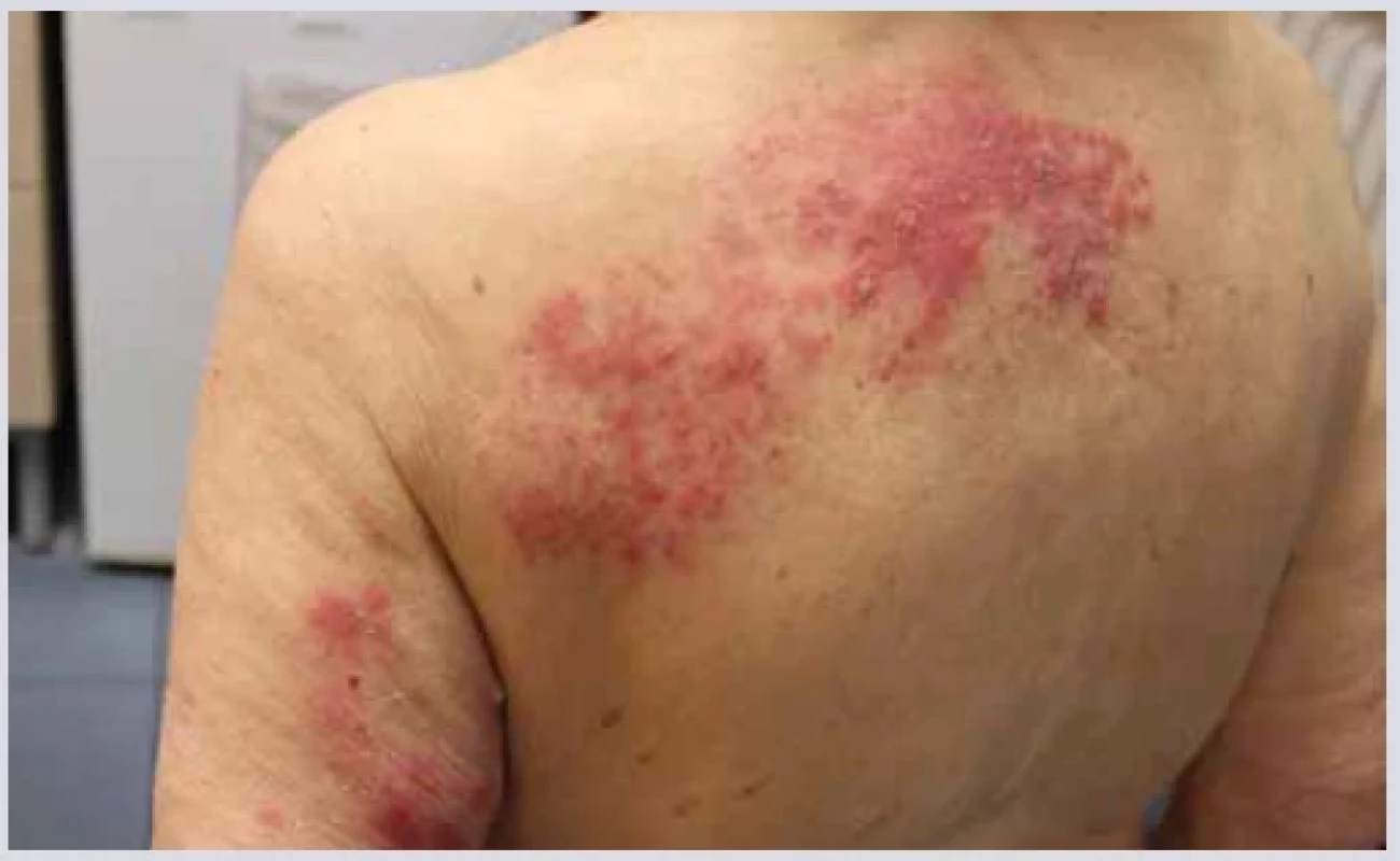 Herpes zoster. ,br> 
Fig. 4. Shingles.