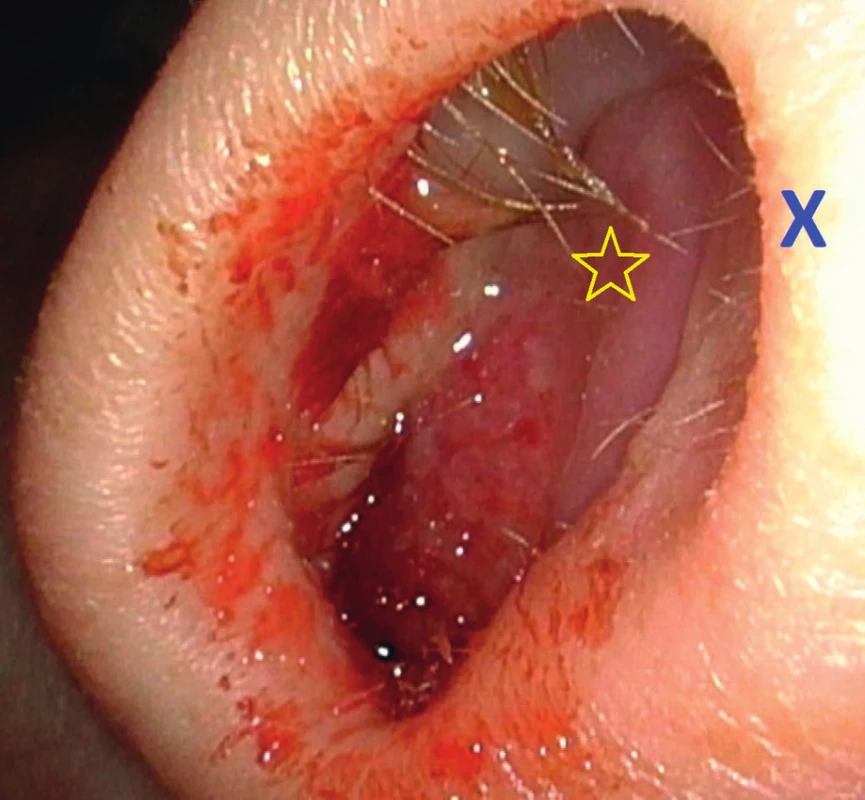 Obturace nosního průduchu vpravo – nález 2. týden od
první návštěvy (hvězdička – tumor, křížek – nosní septum)