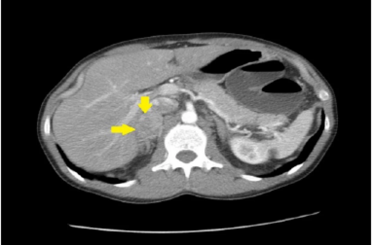 CT nález feochromocytóm pravej nadobličky u nášho pacienta (Materiál II. Rádiologickej kliniky LF UK a OÚSA)