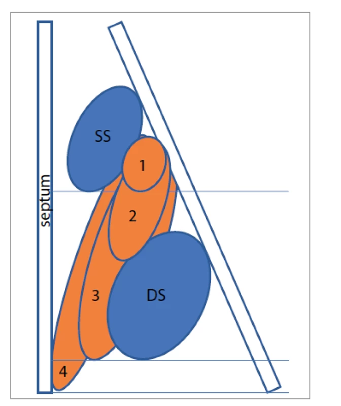 Klasifikace postižení nosní dutiny
pomocí Nasal polyp score.
SS – střední skořepa, DS – dolní skořepa,
1 – polyp po dolní hranu střední
skořepy, 2 – polyp pod dolní hranu
střední skořepy, 3 – polyp po dolní
hranu dolní skořepy nebo polyp mediálně
od střední skořepy, 4 – polyp po
spodinu dutiny nosní<br>
Fig. 2. Classification of nasal involvement
using the Nasal polyp score.
SS – middle turbinate, DS – lower turbinate,
1 – polyp to the lower edge of
the middle turbinate, 2 – polyp below
the lower edge of the middle turbinate,
3 – polyp to the lower edge of the lower
turbinate or polyp medially from the middle
turbinate, 4 – polyp to the base of
the nasal cavity