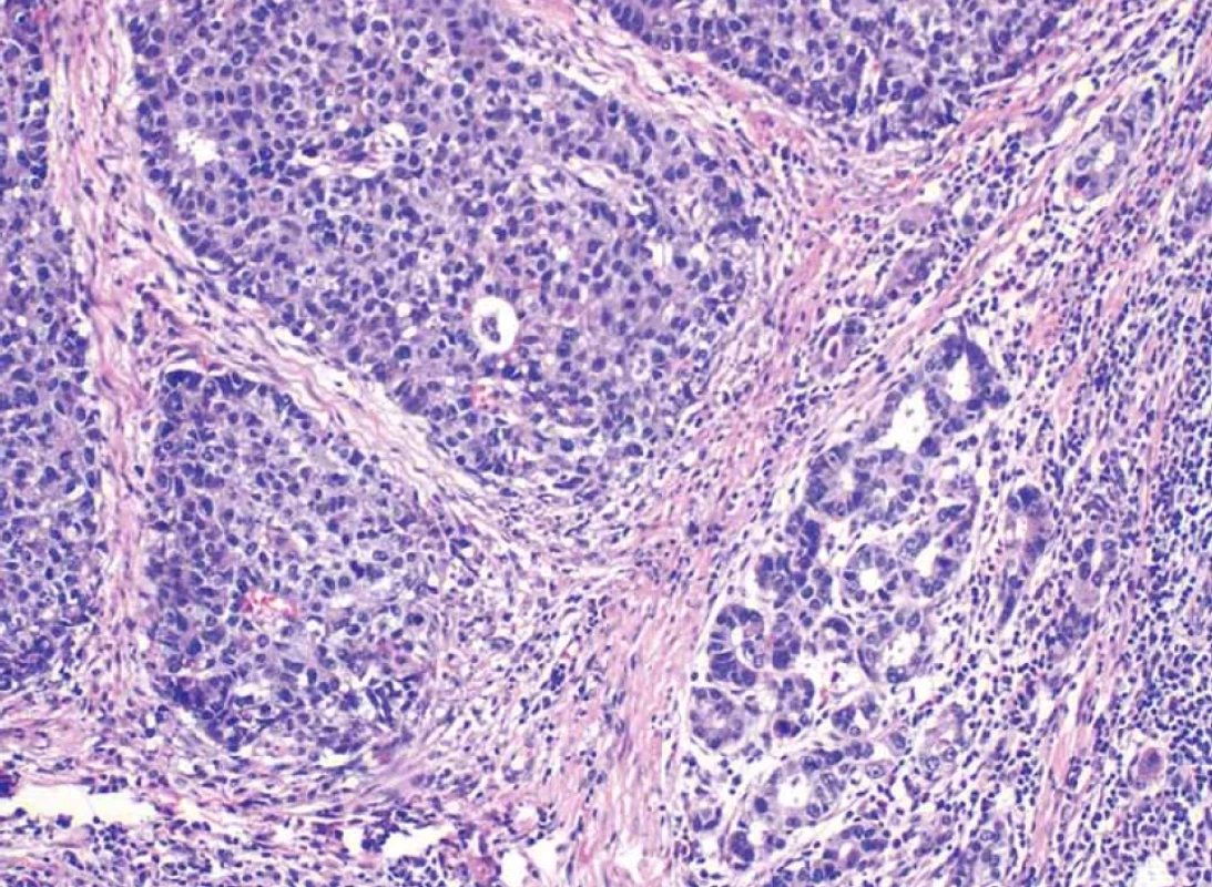 Zvětšení obou složek nádoru – neuroendokrinní vlevo, žlázová vpravo (barvení hematoxilin-eozin).</br>Fig. 10. Enlargement of both components of the tumor – neuroendocrine on the left, glandular on the right (haematoxylin-eosin staining).