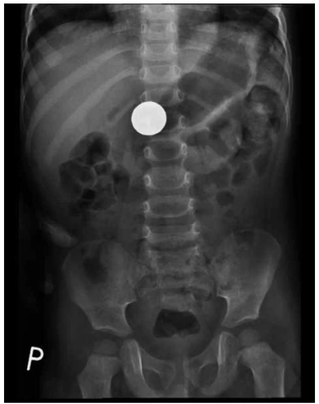 Mince 2 Kč v žaludku (49. den od spolknutí)<br>
Fig. 1. A coin (CZK 2) in the stomach (49th day from ingestion)