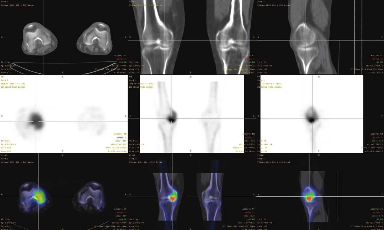 Fúze SPECT/CT obrazu u téhož pacienta s osteonekrózou mediálního kondylu femuru v časném stádiu (I). V horní řadě je obraz
z LDCT postupně v transaxiální, koronární a sagitální rovině. Střední řada ukazuje odpovídající SPECT řezy. Dolní řada prezentuje odpovídající
fúzované SPECT/CT řezy. Scintigrafický nález je v časném stádiu výrazný, nález na LDCT normální.