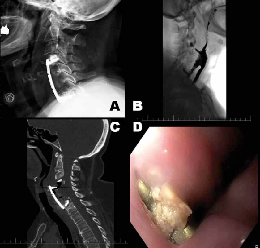 (A) RTG krční páteře 1 rok od primární operace, (B) skiaskopie jícnu zobrazující
uvolněnou dlahu s migrací do jícnu, kontrastní látka uniká podél dlahy, (C) esofagoskopie
zobrazující dlahu prominující v krční části jícnu, (D) CT krku zobrazující uvolněnou
dlahu s migrací do jícnu.<br>
Fig. 1. (A) X-ray of the neck spine 1 year after primary surgery, (B) esophageal fluoroscopy
showing the disengaged plate with migration to the esophagus, contrast
agent is spilling out along the plate, (C) esophagoscopy depicting a plate migrated to
the cervical part of the esophagus, (D) neck CT scan showing the disengaged plate with
migration to the esophagus.