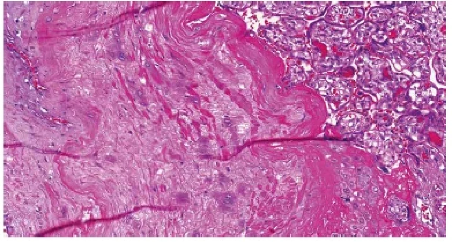 Placenta accreta. Choriové klky jsou od myometria odděleny pouze
vrstvou fibrinu, v němž jsou rozptýleny buňky extravilózního trofoblastu
(HE, 200x).
