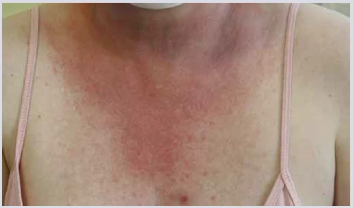 Lupus-like syndrom. <br> 
Fig. 7. Lupus-like syndrome.