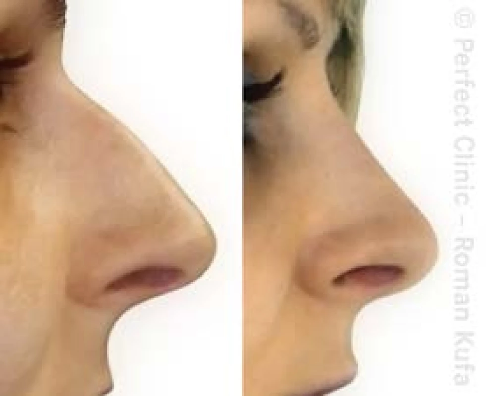 Nos před operací a po ní