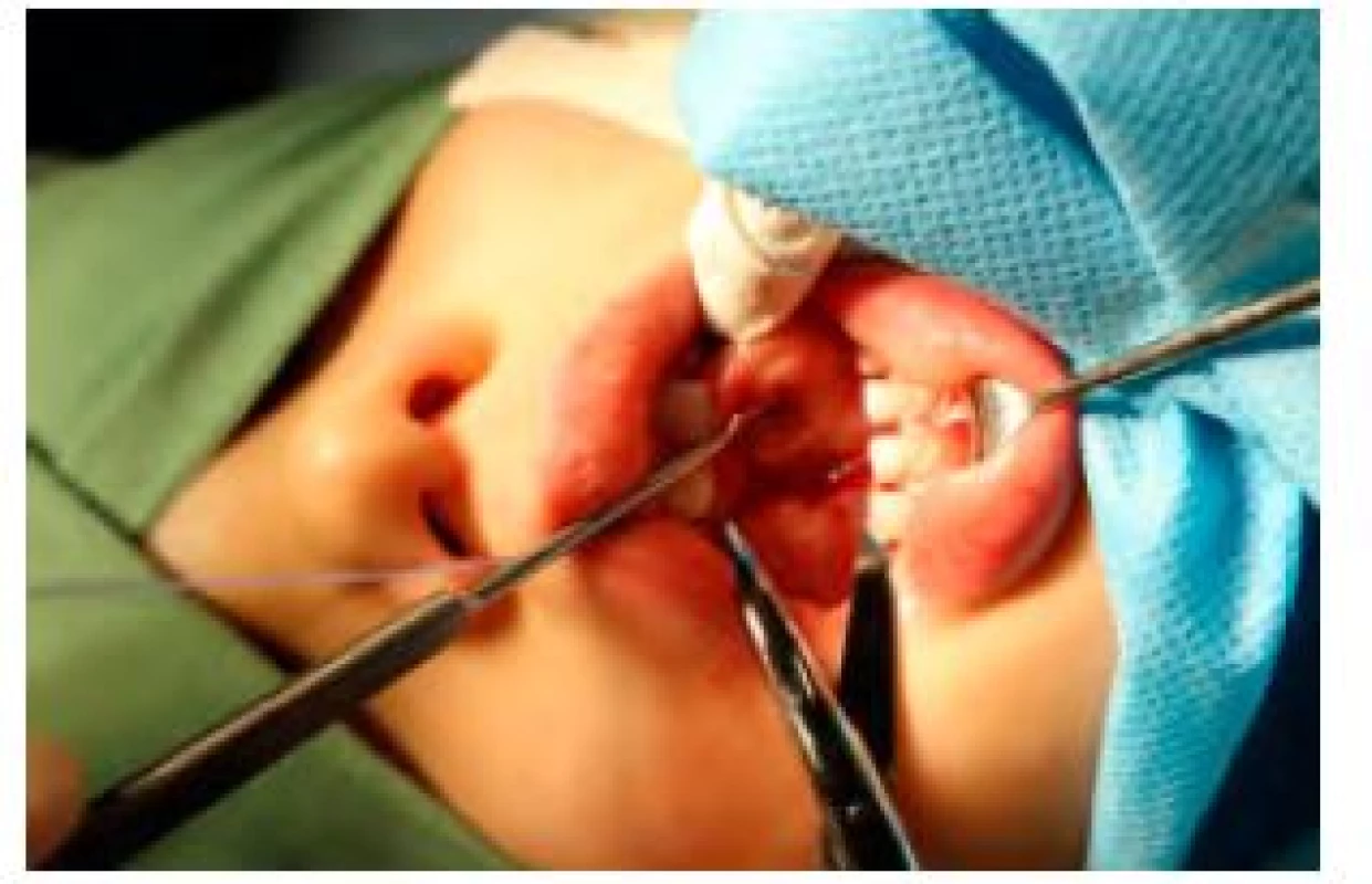 Chirurgické uvolnění podjazykové uzdičky a mezisvalového septa