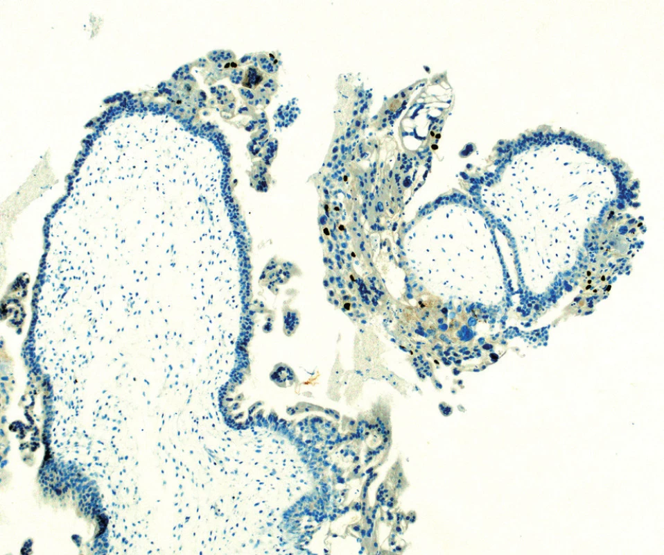 Histologický preparát – imumunochistochemie p57<br>
Kompletní mola hydatidosa. Vilózní cytotrofoblast a buňky
stromatu jsou negativní na imunohistochemii p57. Intermediální
trofoblast slouží jako vnitřní pozitivní kontrola.