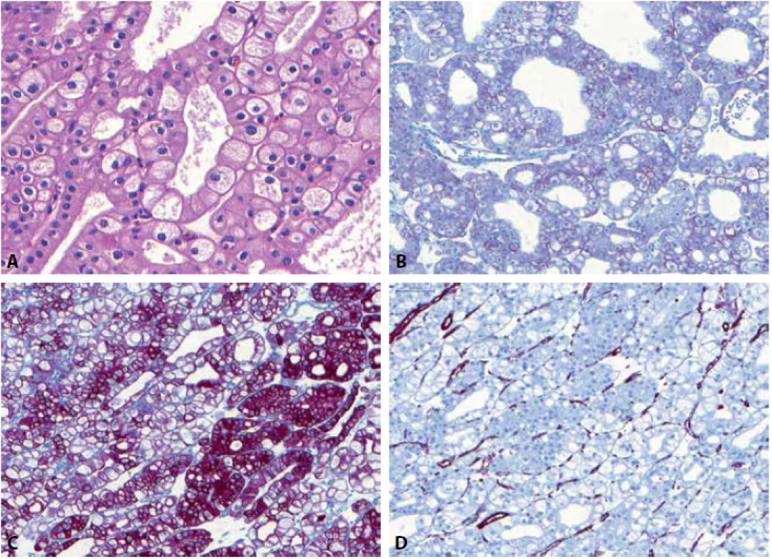 Chromofóbní renální karcinom s typickými raisinoidními jádry a perinukleárním projasněním (A). Nádor je pozitivní v průkazu CD117 (B) a CK7 (C) a negativní v barvení vimentinem (D).