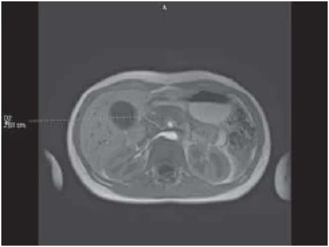 Změněný signál a hraniční šíře
hlavy pankreatu na MR v T1 sekvenci. <br> 
Fig. 1. Changed signal and border width of
the pancreatic head on MRI in T􀍷 sequence.