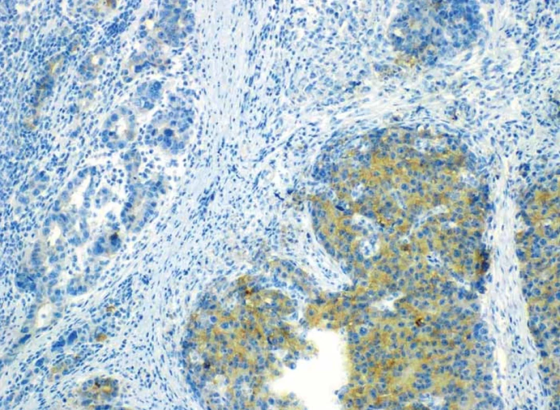 Imunohistochemický průkaz neuroendokrinního markeru synaptofysinu pozitivní v neuroendokrinní složce karcinomu – vlevo, hnědá barva.</br>Fig. 11. Immunohistochemical evidence of the neuroendocrine marker synaptophysin positive in the neuroendocrine component of carcinoma – left, brown color.