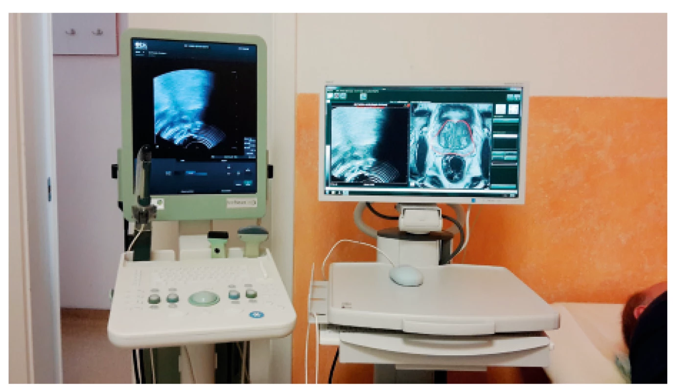 Přístrojové vybavení pro TRUS/MRI biopsii:
ultrazvukový přístroj FlexFocus 400 s endorektální sondou
8808e (vlevo) a fúzní jednotka BiopSee (vpravo)