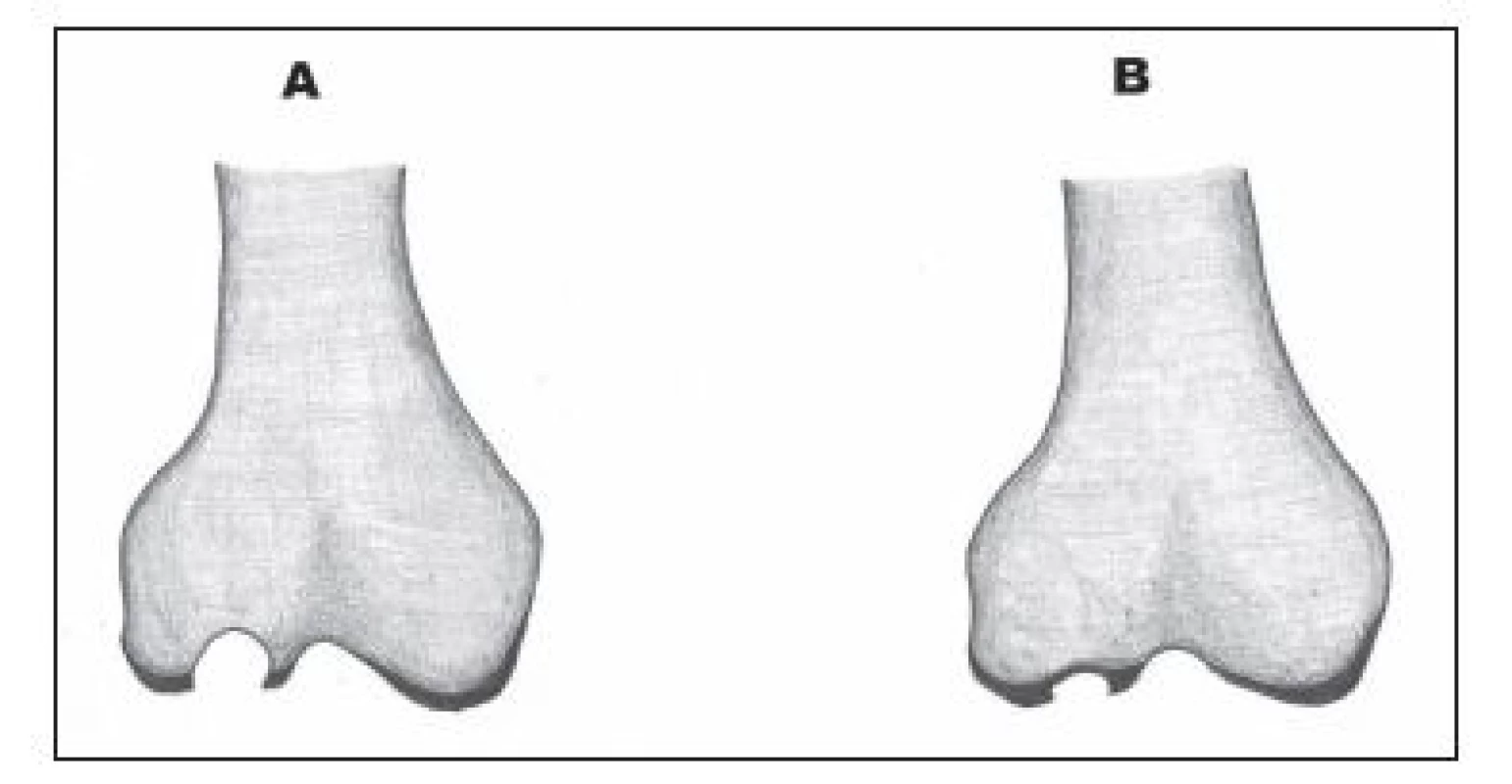 Pozdní (A) a časné (B) stádium osteochondrálního defektu.