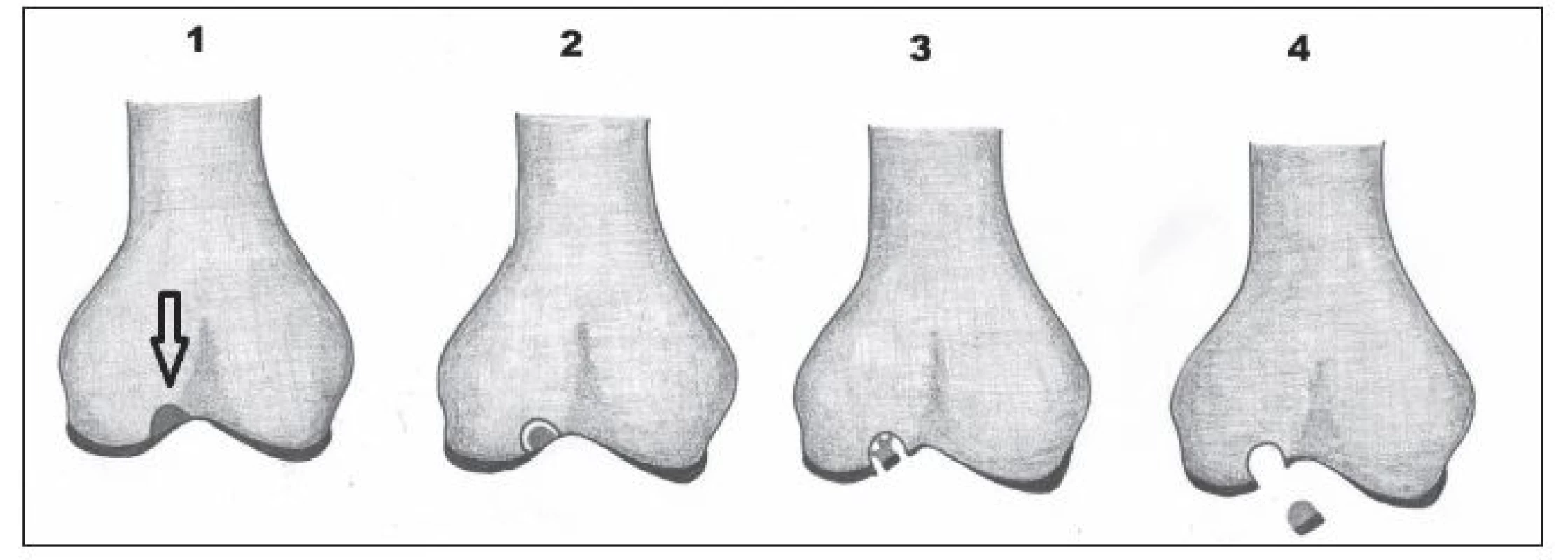 Stádia disekující osteochondritidy 1–4. 1 – vyznačená stabilní léze v kosti, 2 – naznačené odloučení fragmentu v kosti,
3 – fragmentace chrupavky, 4 – dislokace fragmentu.