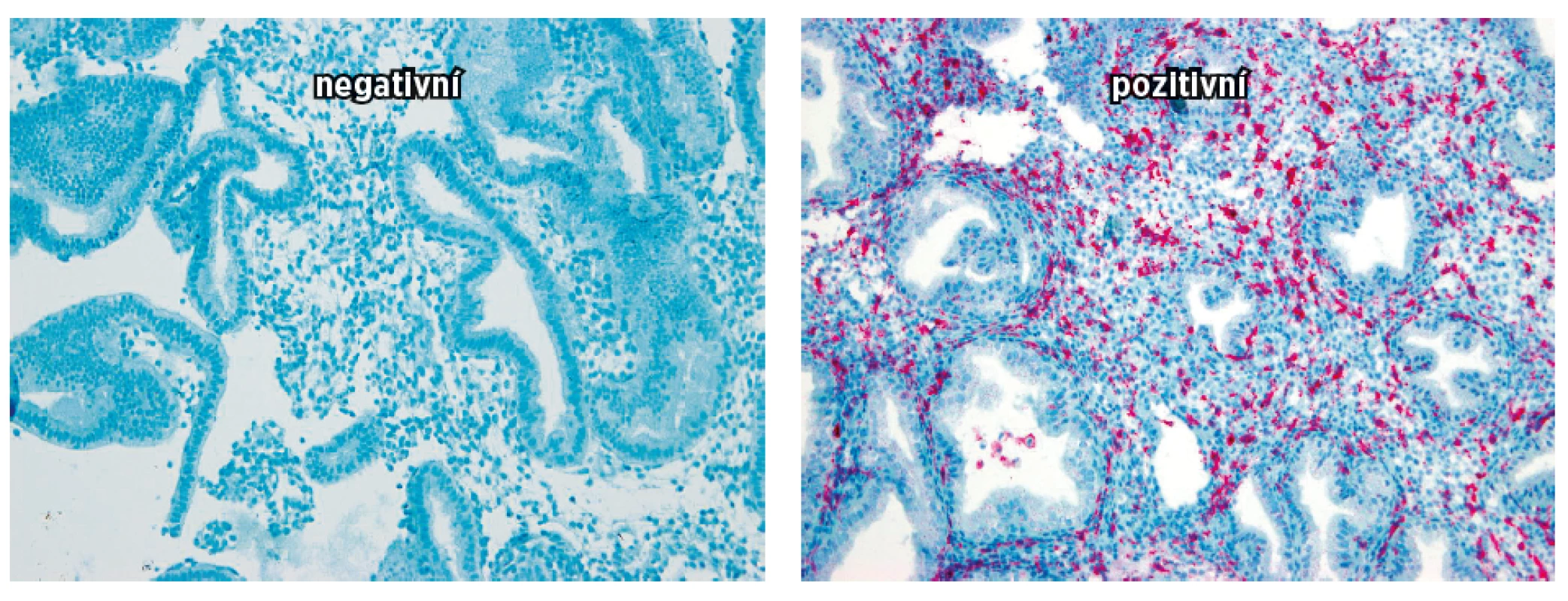 Na obrázku jsou vyjádřeny denzity endometriálních NK buněk CD 16 negativní a pozitivních