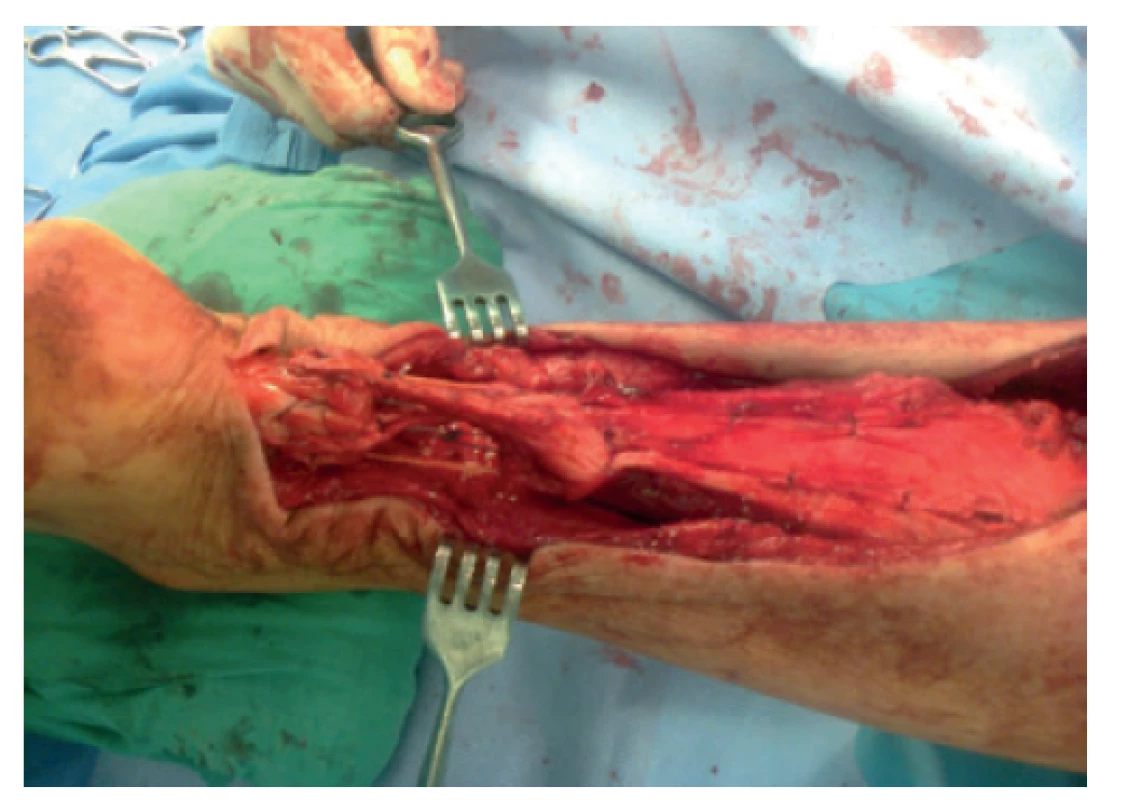 Provedena flap-turn plastika dle Lindholma
s O-augmentací šlachou m. plantaris<br>
Fig. 8: Flap-turn plasty using the Lindholm technique and
O-shaped augmentation with the plantaris muscle were
performed