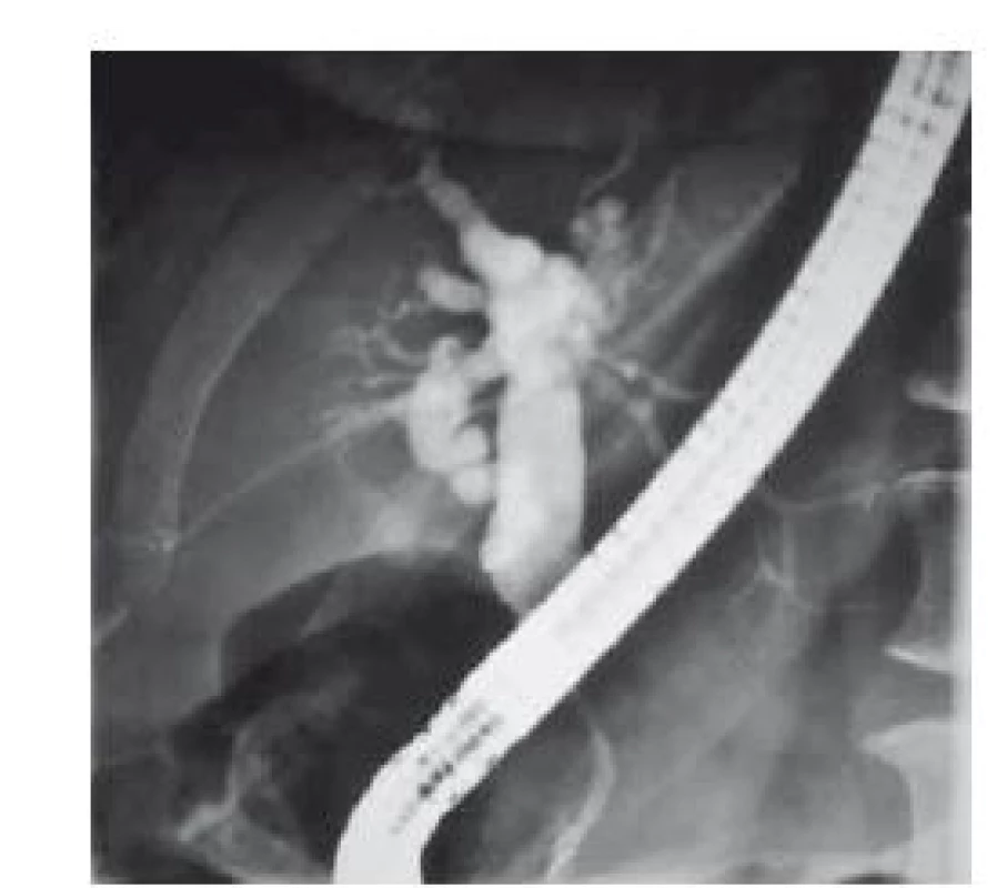 Stenóza distální části ductus choledochus s dilatací extra i intrahepatálních žlučových cest.<br>
Fig. 1. Terminal common bile duct stenosis
with dilatation extra and intrahepatic
bile ducts.