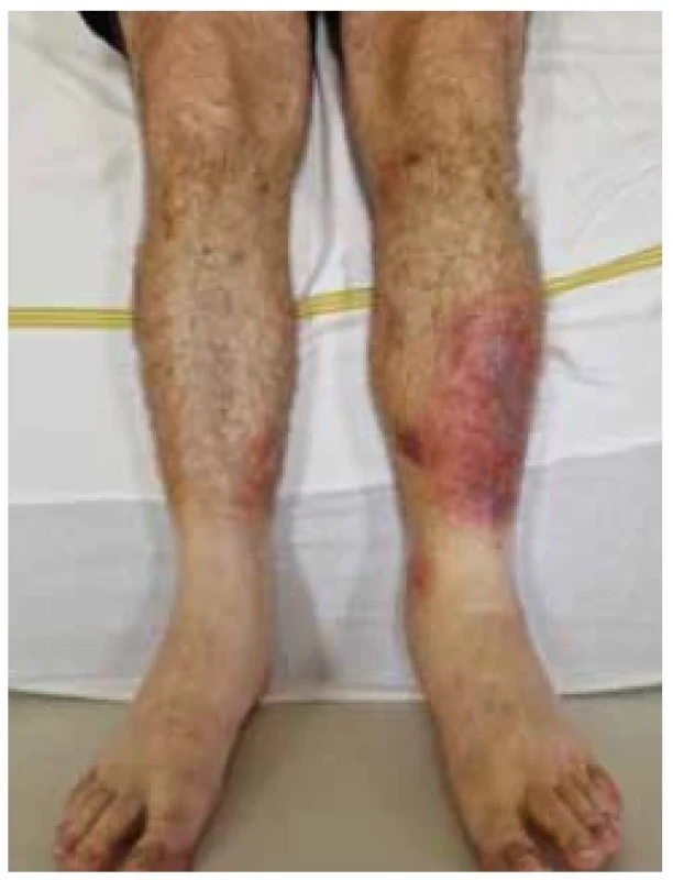 Erytematózní ložiska na
bércích. <br> 
Fig. 1. Erythematous deposits on the
lower legs.