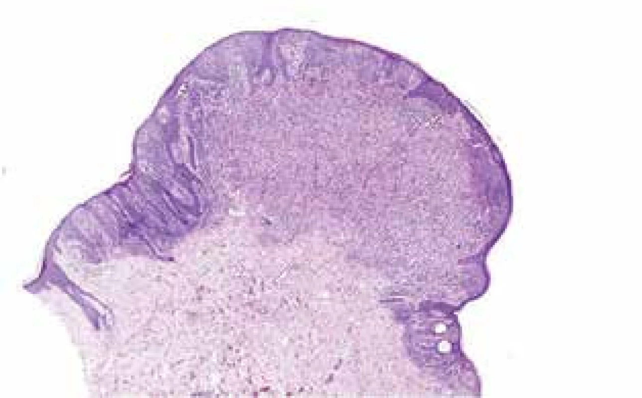 Histologický nález – uprostřed melanom, v okrajích névus
(HE, zvětšení 20x)