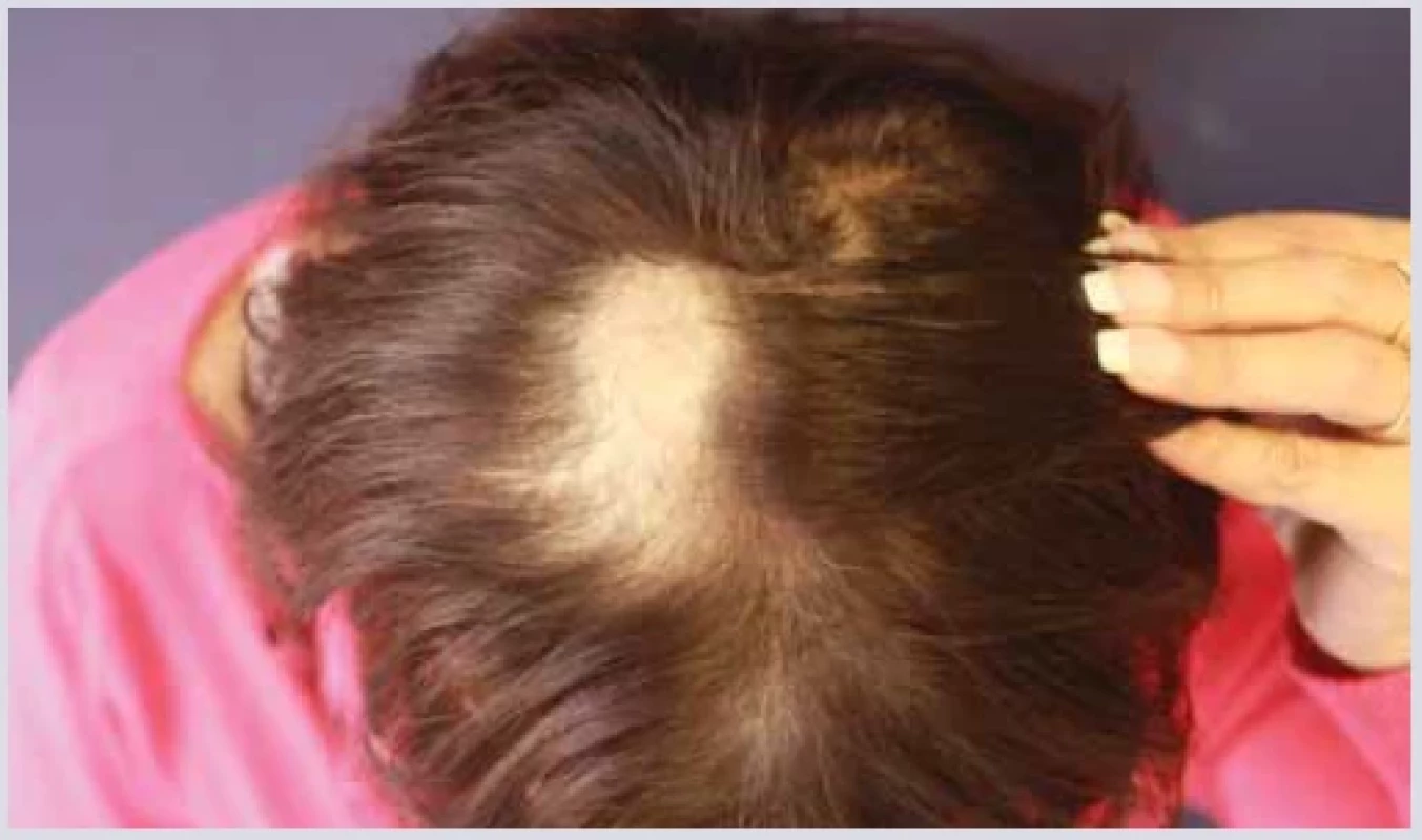 Alopecia areata. <br> 
Fig. 11. Alopecia areata.