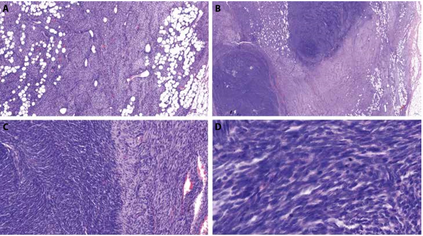 Foto z digitálního scanu histologického preparátu z radikální excize tumoru.<br> A – klasická morfologie DFSP vykazující  storiformní „rohožkovité“ uspořádání blandních buněk v lehce bazofilním stromatu, zachovávající adipocyty, HE, 7x.<br> B – uvnitř DFSP jsou dva nápadně buněčné fibrosarkomatózní noduly, HE, 1,7x.<br> C – rozhraní „klasického“ DFSP a fibrosarkomatózního úseku, HE, 17x.<br> D – detail fibrosarkomatózního úseku s hyperchromními jádry a mitózami, HE, 73x.