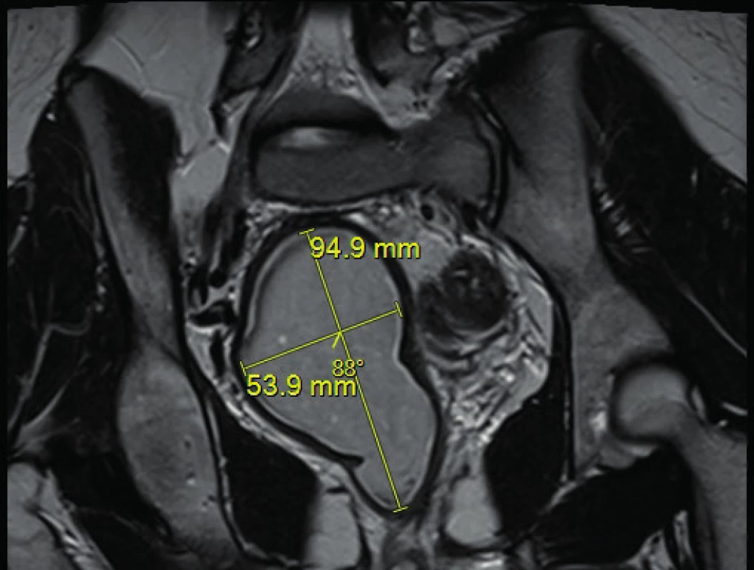 MRI snímek pánve nativně T2 v koronární projekci
s určením rozměrů hematokolpos
