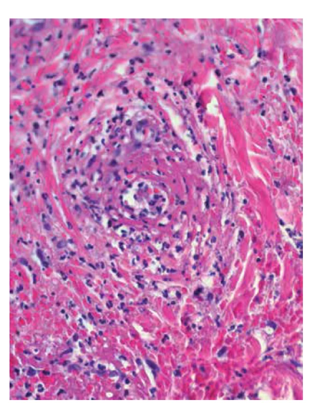 Leukocytoklastická vaskulitida: eozinofilní depozita
fibrinu ve stěnách cév, erytrocytární extravazáty, neutrofily
s fragmentací jader – leukocytoklazií (HE 400x)
