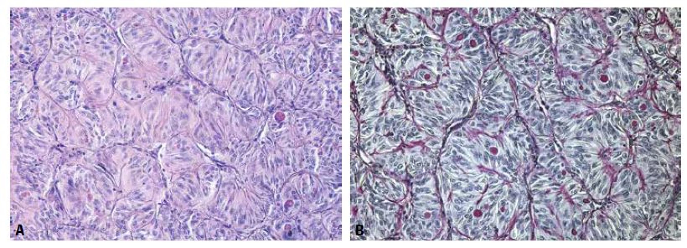 Solidně-alveolárně uspořádané protáhlé nádorové buňky s protáhlými až okrouhlými jádry a PAS pozitivními eosinofilními globulemi v cytoplazmě.
(A - barvení hematoxylinem eozinem, zvětšení 200x, B - barvení PAS, zvětšení 200x).