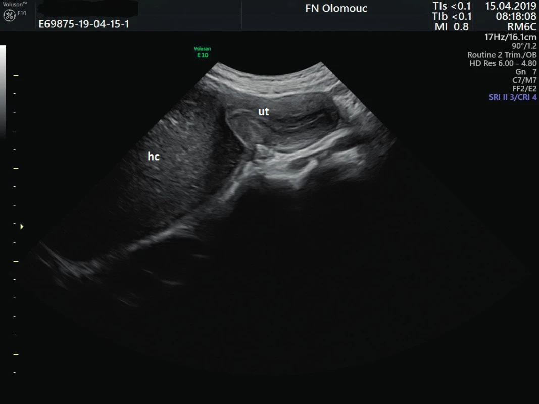 Ultrazvukový snímek hematokolpos v sagitální projekci
abdominální sondou
ut – uterus, hc – hematokolpos