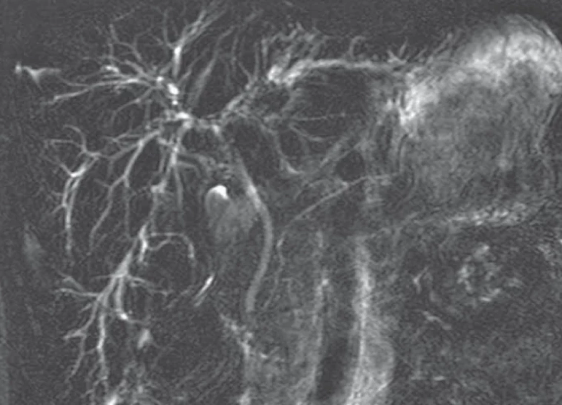 Obraz magnetické rezonanční cholangiografie u pacienta s laboratorní cholestázou.</br>Fig. 1. Image of magnetic resonance cholangiography in a patient with laboratory cholestasis.