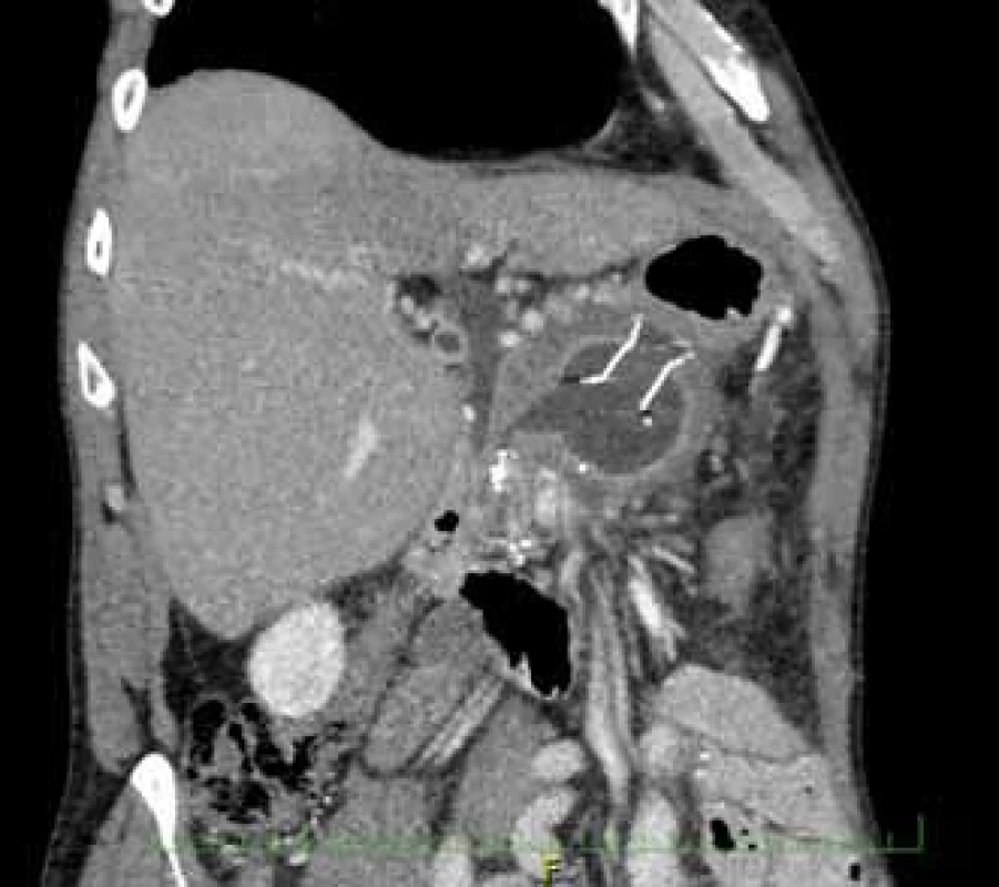 CT břicha demonstrující cystoid s migrovaným stentem Niti-S NAGI™.<br> Fig. 1. Computer tomography of the abdomen showing a migrating Niti-S NAGI™ stent in a cystoid.